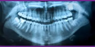 رادیولوژی دندان در فرمانیه